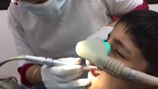 Dental Treatment under Laughing Gas Anaesthesia [upl. by Amilb]